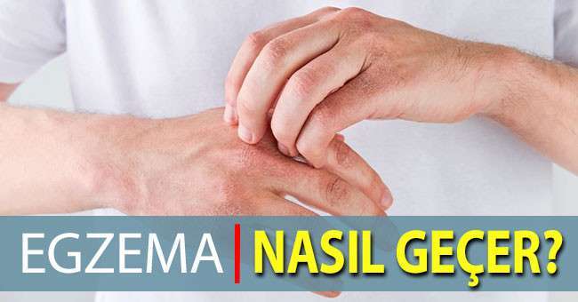 Egzema Nasıl Geçer?