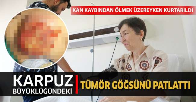 Karpuz büyüklüğündeki tümör göğsünü patlattı