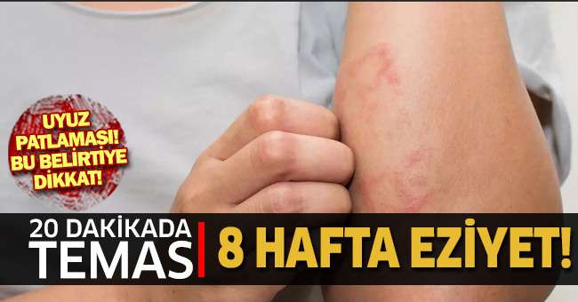 Uyuz, 15 dakikalık temasla bulaşıyor